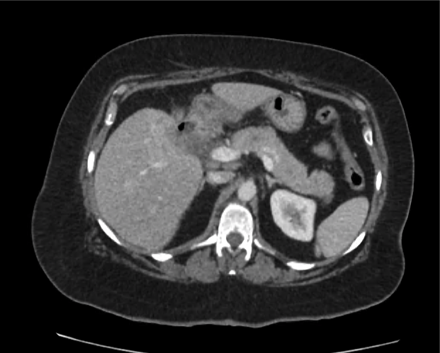 cyst-gastric_10