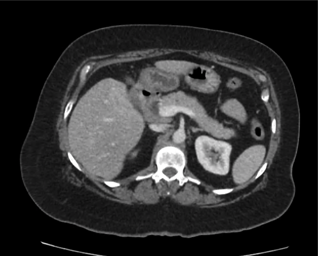 cyst-gastric_11