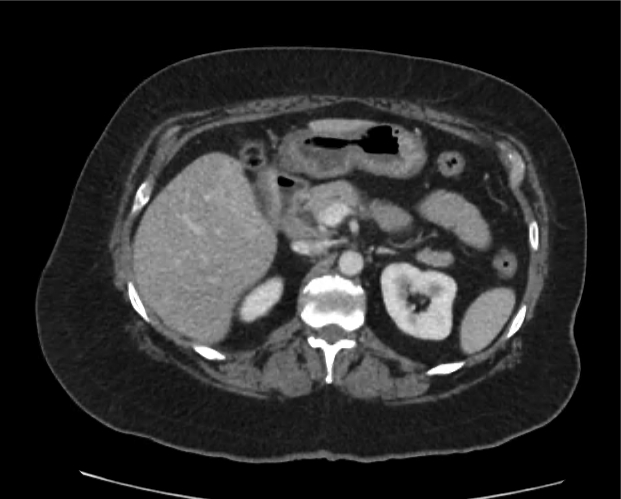 cyst-gastric_12