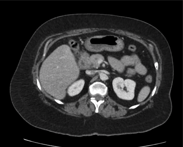 cyst-gastric_13