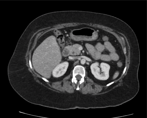 cyst-gastric_14