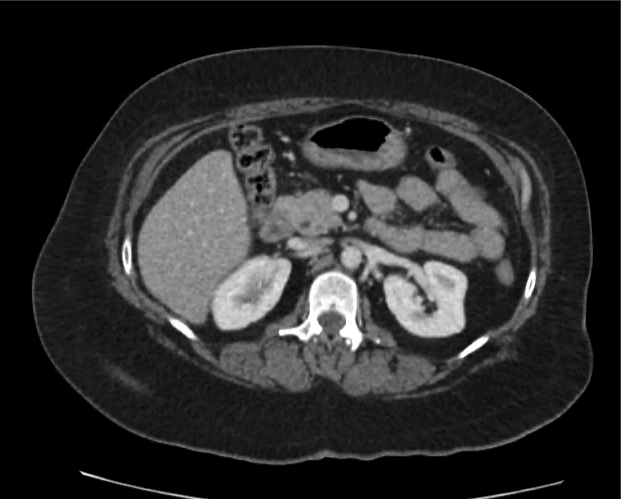 cyst-gastric_15