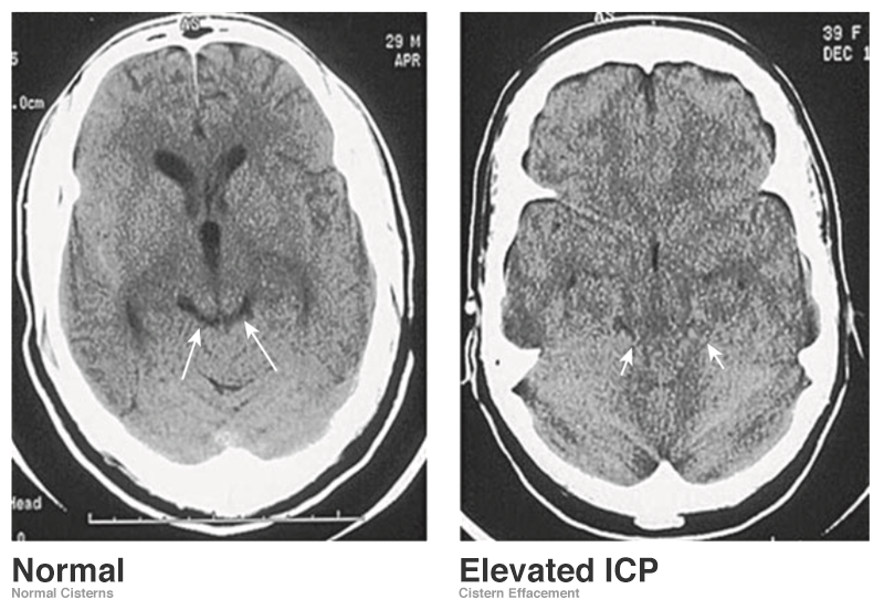 icp - Differential Diagnosis of