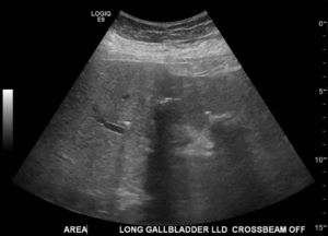 Right upper quadrant ultrasound