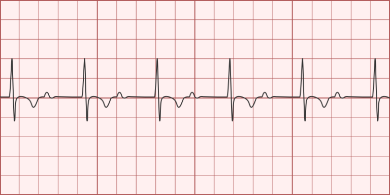 1st Degree Av Block Differential Diagnosis Of