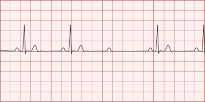 2nd Degree AV Block (Mobitz Type II) - Differential Diagnosis of