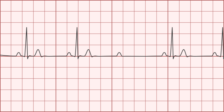 2nd-degree-av-block-mobitz-type-ii-differential-diagnosis-of