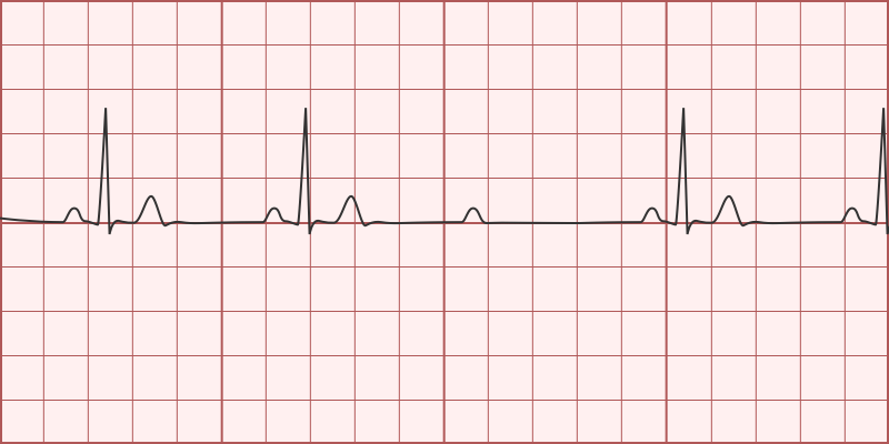 2nd Degree AV Block Mobitz Type II Differential Diagnosis Of