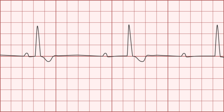 3rd Degree AV Block - Differential Diagnosis of