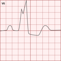 Left Bundle Branch Block (Part 2) - Differential Diagnosis of