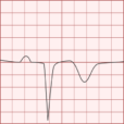 Pathologic Q-wave - Differential Diagnosis of