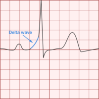 WPW - Differential Diagnosis of