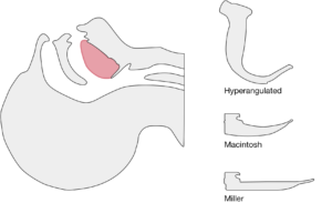 larynx - Differential Diagnosis of