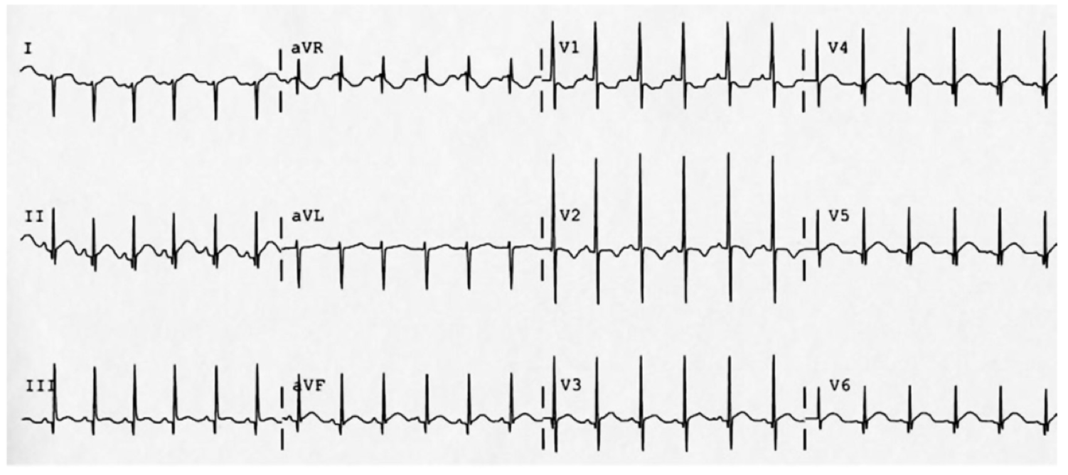 Normal Pediatric Ecg