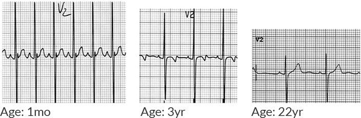 Normal Pediatric Ecg