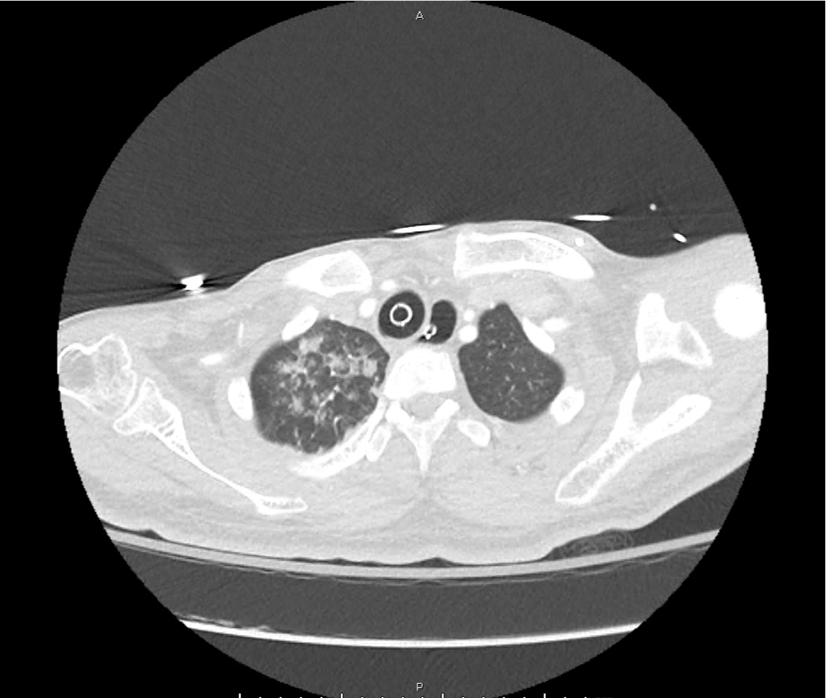 leukemoid_ct_01