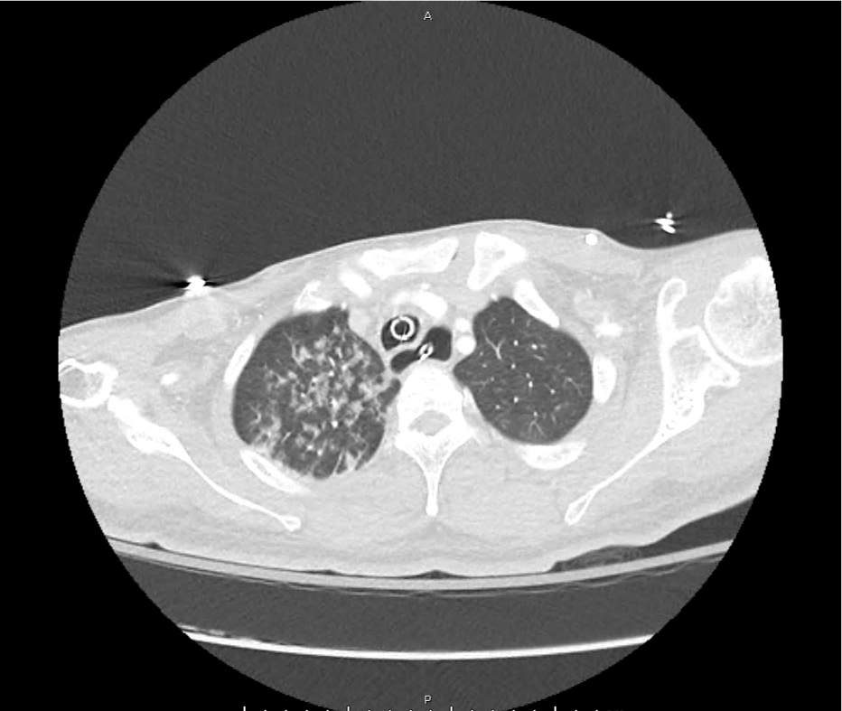 leukemoid_ct_02