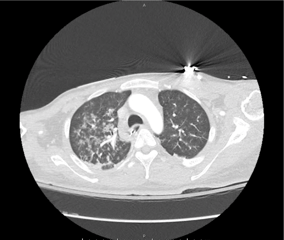 leukemoid_ct_04