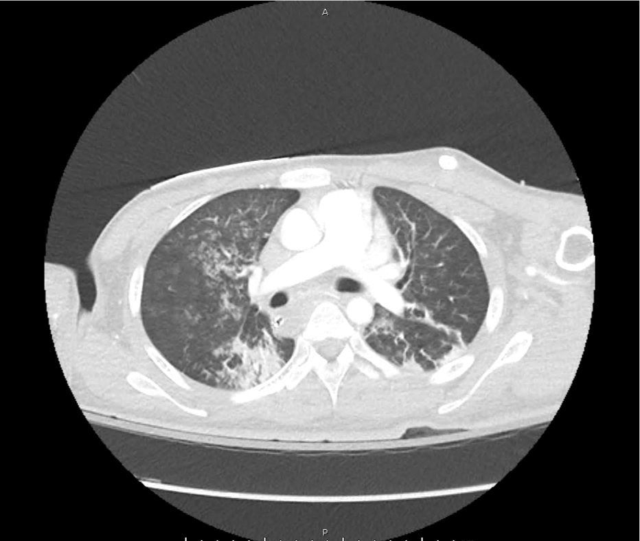 leukemoid_ct_06