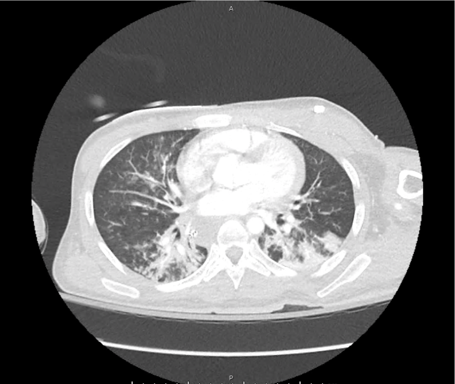 Leukocytosis Tags - Differential Diagnosis of