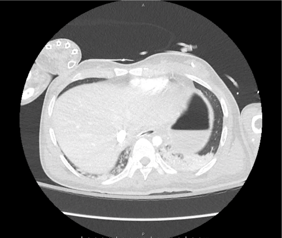 leukemoid_ct_12