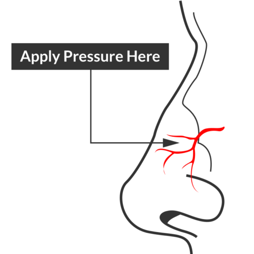 Differential Diagnosis of Epistaxis