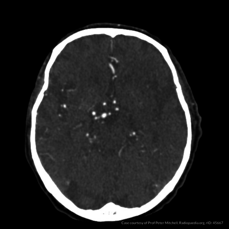 mca stroke icd 9