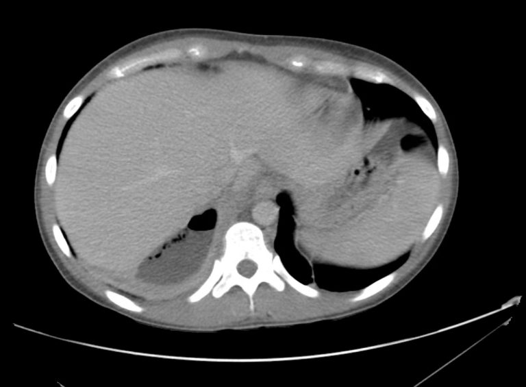 04_pyelo Differential Diagnosis of