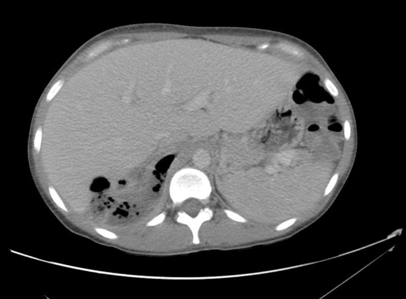 08_pyelo Differential Diagnosis of