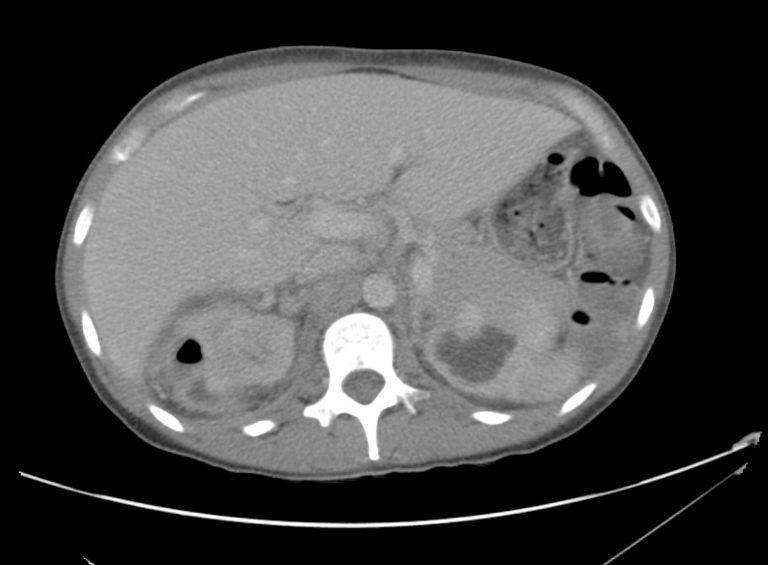 10_pyelo Differential Diagnosis of