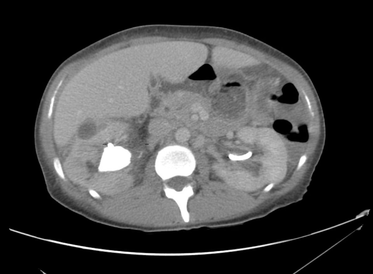 14_pyelo Differential Diagnosis of