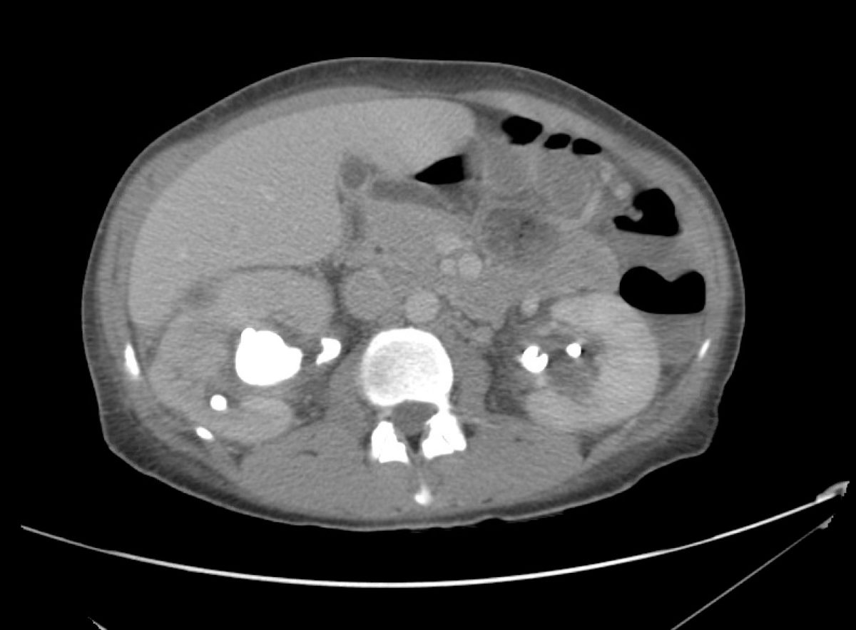 15_pyelo Differential Diagnosis of