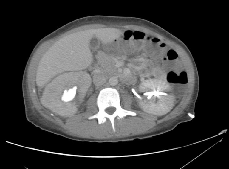 16_pyelo Differential Diagnosis of