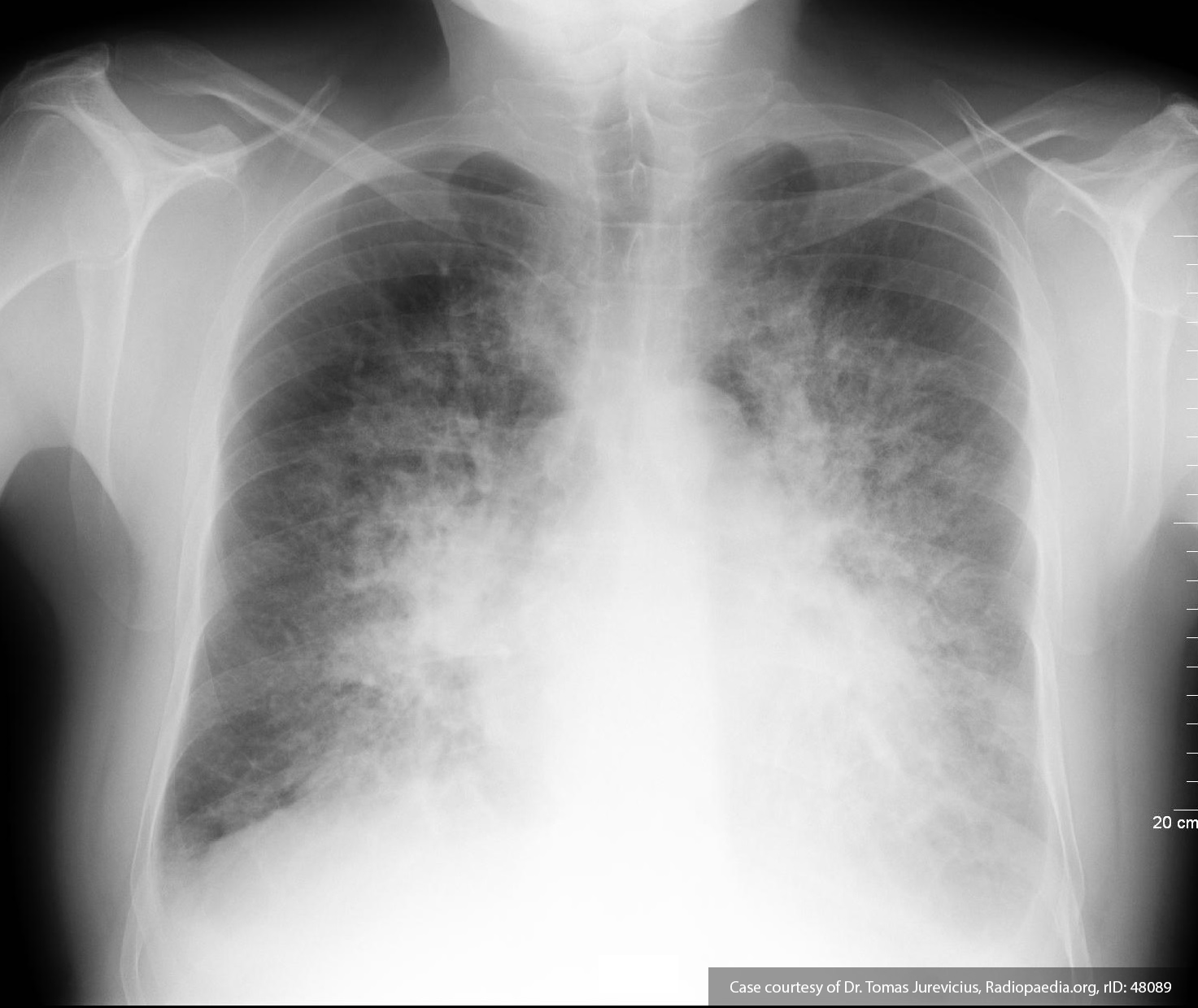 Chest x-ray with pulmonary edema