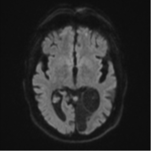 acute-lacunar-infarct (5) - Differential Diagnosis of