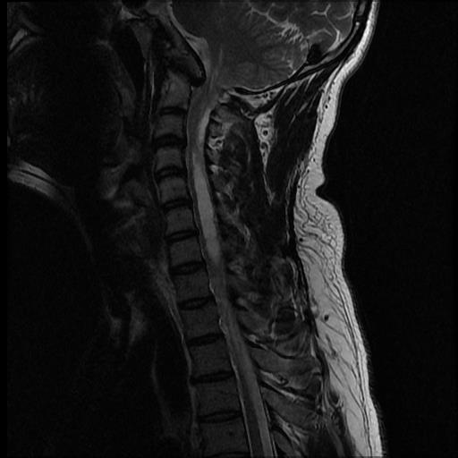 chiari-1-malformation-with-secondary-cervicothoracic-syringomyelia (3 ...