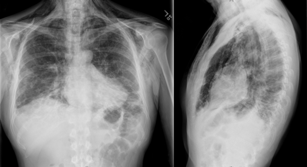 Chest x-ray showing pneumomediastinum