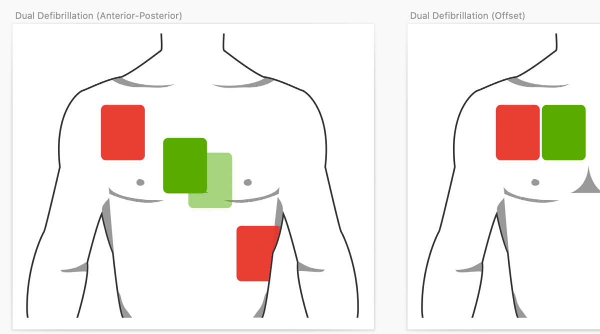 defibrillation Differential Diagnosis of