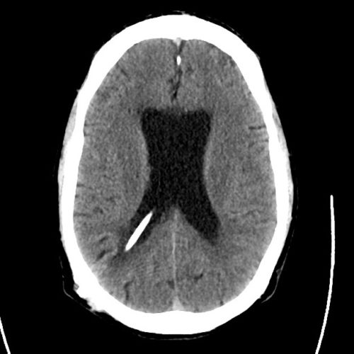 09_ct_csf_shunt - Differential Diagnosis of