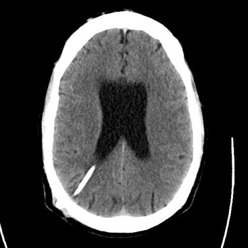 10 Ct Csf Shunt - Differential Diagnosis Of