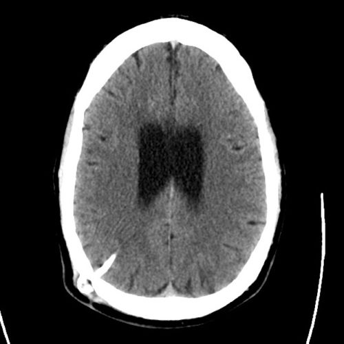 11_ct_csf_shunt - Differential Diagnosis of