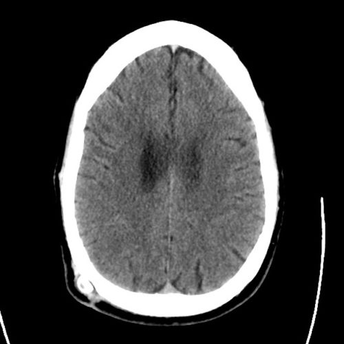 12_ct_csf_shunt - Differential Diagnosis of