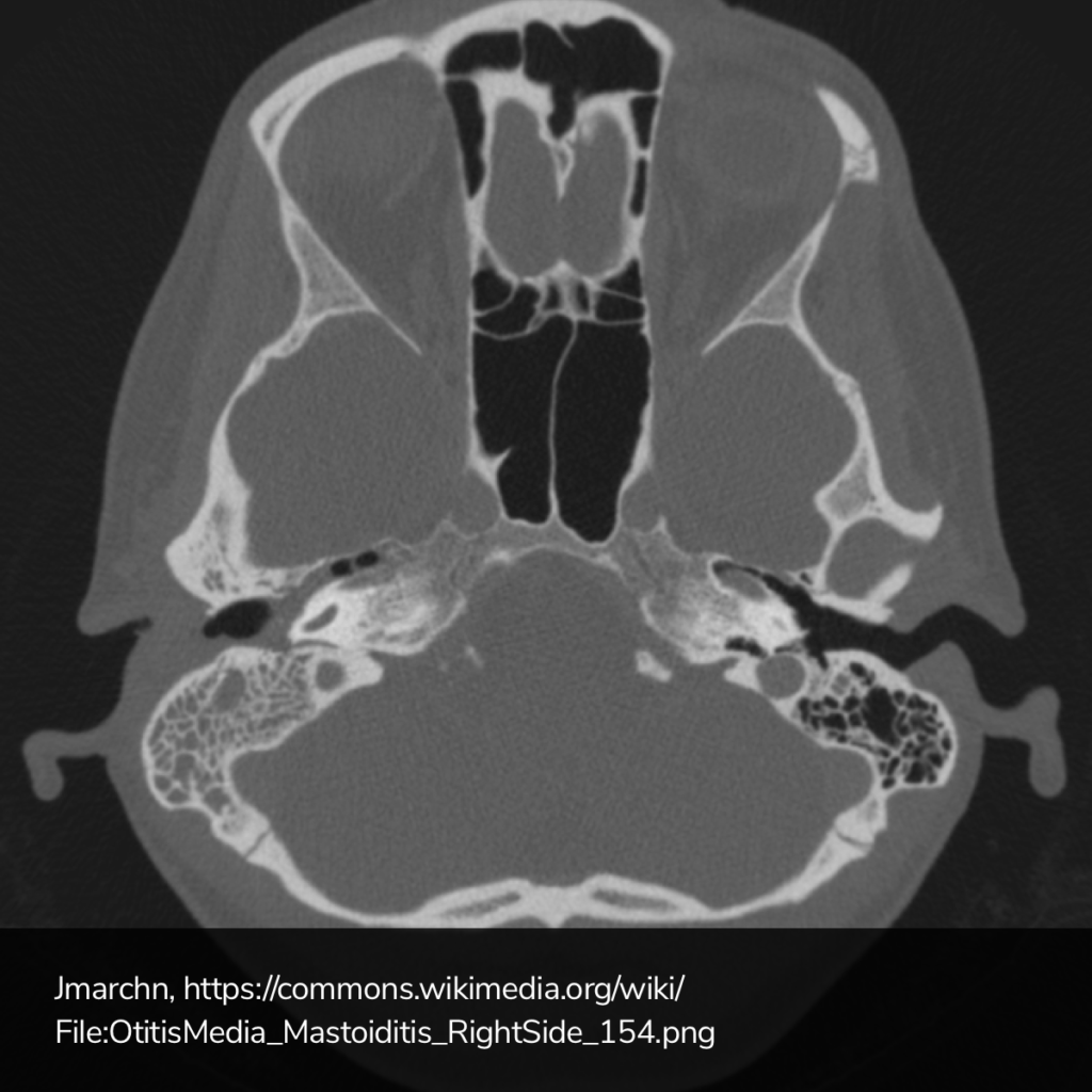 Mastoiditis on CT