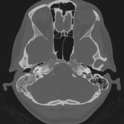 Mastoiditis