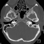 CT suggestive of malignant otitis externa