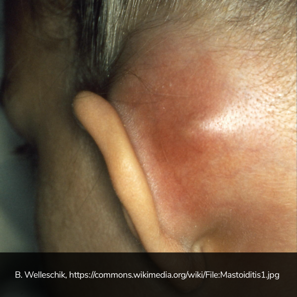 Mastoiditis