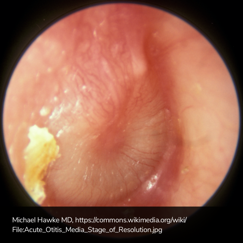 Otitis Media