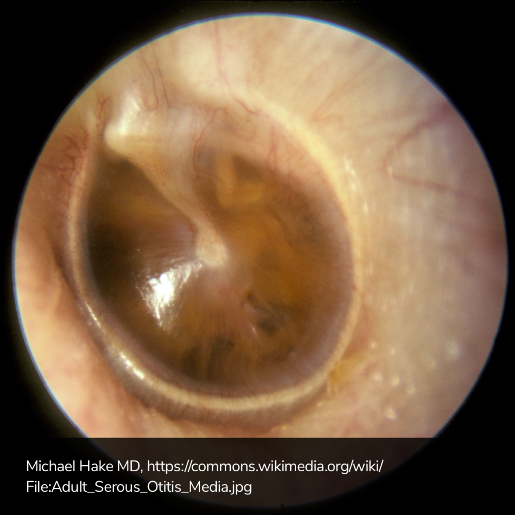 Serous Otitis Media