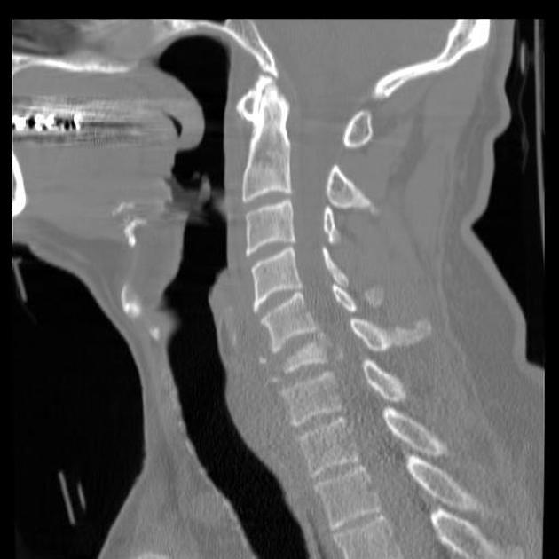 icd-10-code-for-left-upper-extremity-monoparesis