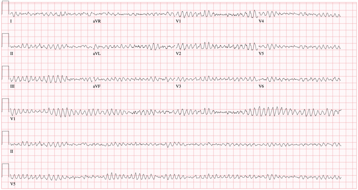 status post lvad placement icd 10